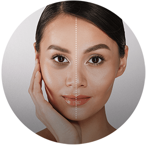 Tratamiento de Ojeras